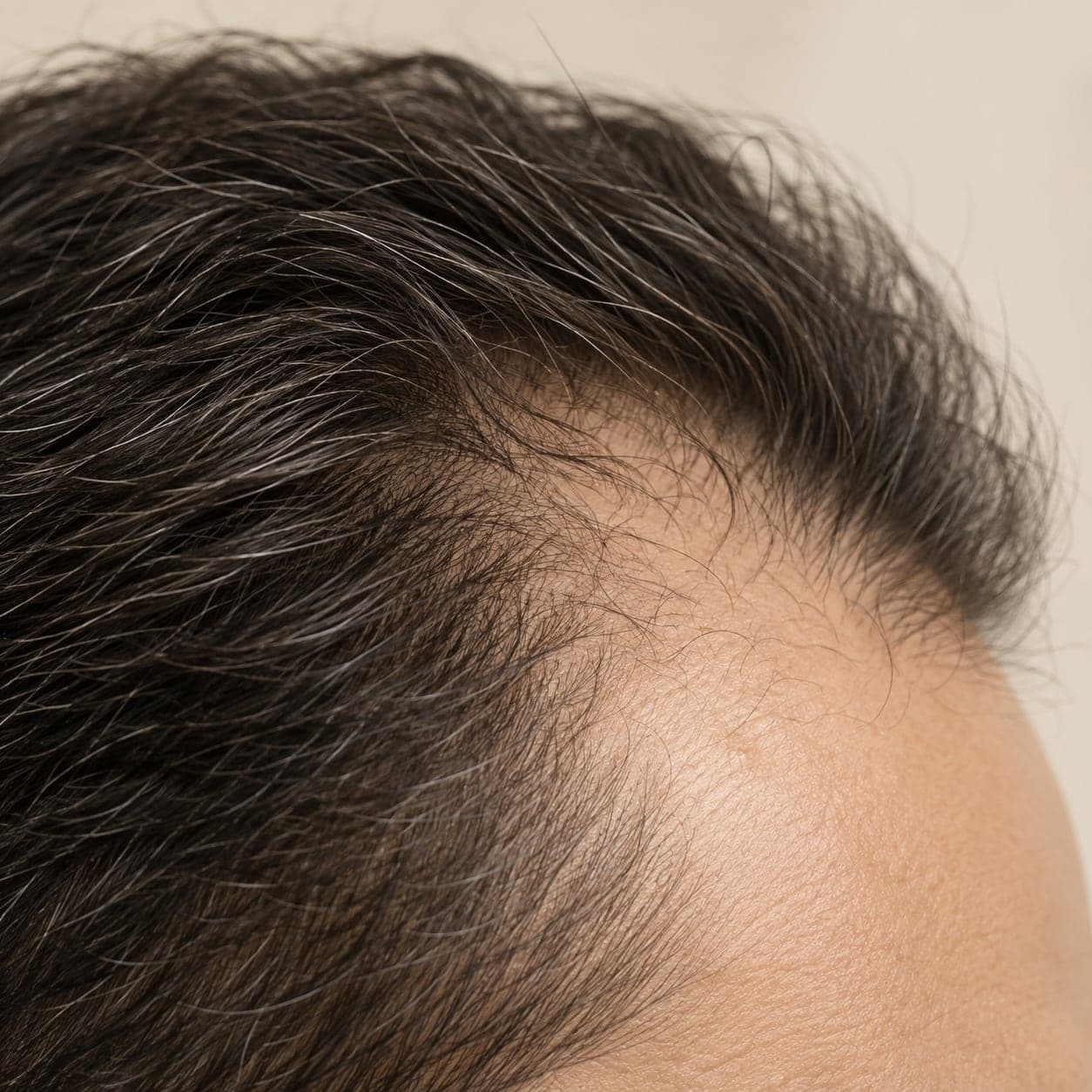 Close crop of a thinning hairline, no face