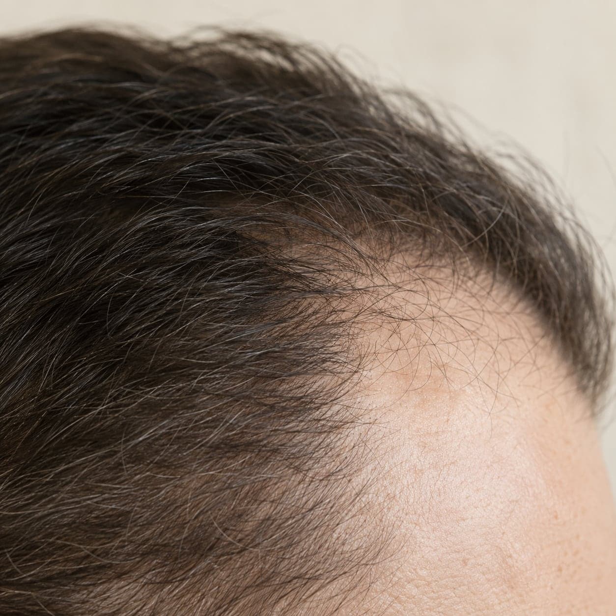 Close crop of a thinning hairline, no face